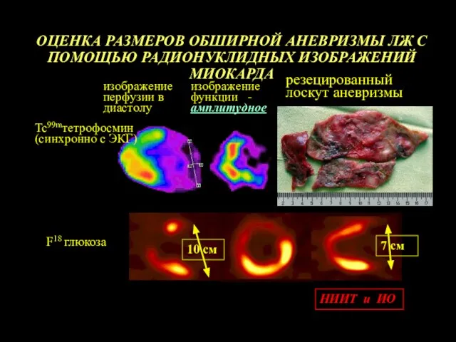 F18 глюкоза ОЦЕНКА РАЗМЕРОВ ОБШИРНОЙ АНЕВРИЗМЫ ЛЖ С ПОМОЩЬЮ РАДИОНУКЛИДНЫХ ИЗОБРАЖЕНИЙ МИОКАРДА