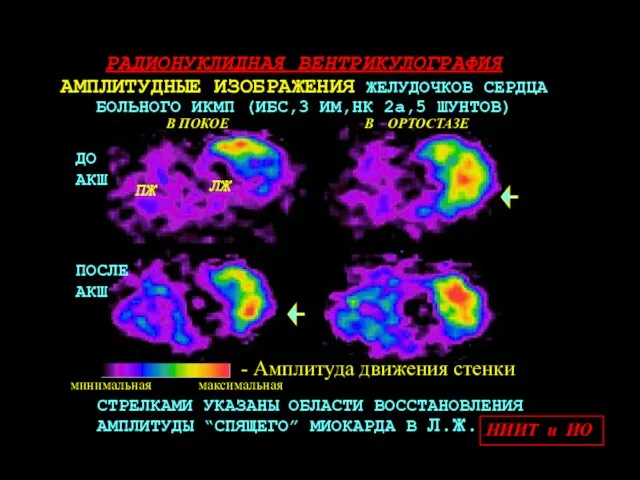 ПЖ ЛЖ ДО АКШ ПОСЛЕ АКШ СТРЕЛКАМИ УКАЗАНЫ ОБЛАСТИ ВОССТАНОВЛЕНИЯ АМПЛИТУДЫ “СПЯЩЕГО”