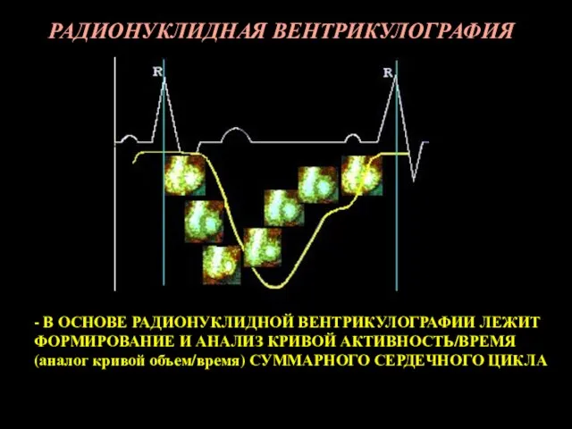 РАДИОНУКЛИДНАЯ ВЕНТРИКУЛОГРАФИЯ - В ОСНОВЕ РАДИОНУКЛИДНОЙ ВЕНТРИКУЛОГРАФИИ ЛЕЖИТ ФОРМИРОВАНИЕ И АНАЛИЗ КРИВОЙ