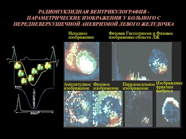 РАДИОНУКЛИДНАЯ ВЕНТРИКУЛОГРАФИЯ - ПАРАМЕТРИЧЕСКИЕ ИЗОБРАЖЕНИЯ У БОЛЬНОГО С ПЕРЕДНЕВЕРХУШЕЧНОЙ АНЕВРИЗМОЙ ЛЕВОГО ЖЕЛУДОЧКА