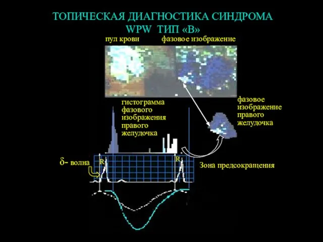 R δ- волна R пул крови фазовое изображение фазовое изображение правого желудочка