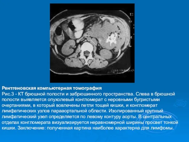 Рентгеновская компьютерная томография Рис.3 - КТ брюшной полости и забрюшинного пространства. Слева