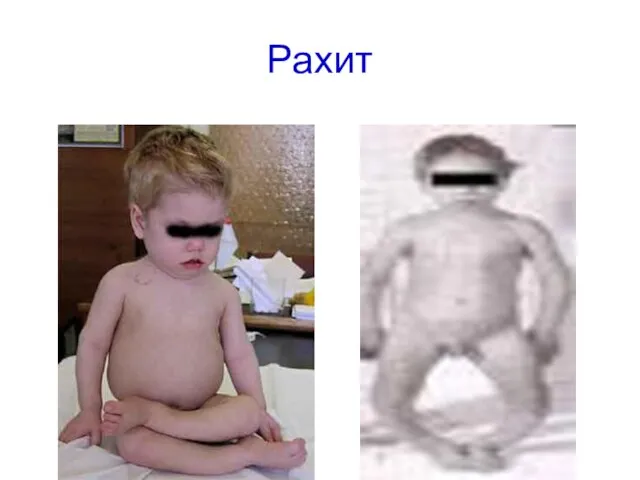 Рахит