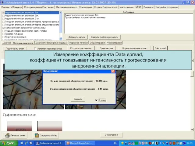 Измерение коэффициента Data spread, коэффициент показывает интенсивность прогрессирования андрогенной алопеции.