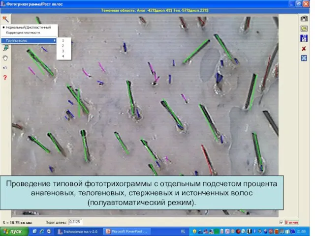 Проведение типовой фототрихограммы с отдельным подсчетом процента анагеновых, телогеновых, стержневых и истонченных волос (полуавтоматический режим).