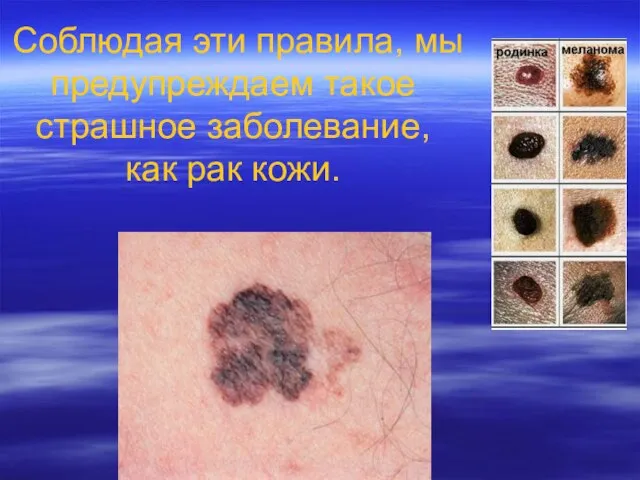 Соблюдая эти правила, мы предупреждаем такое страшное заболевание, как рак кожи.