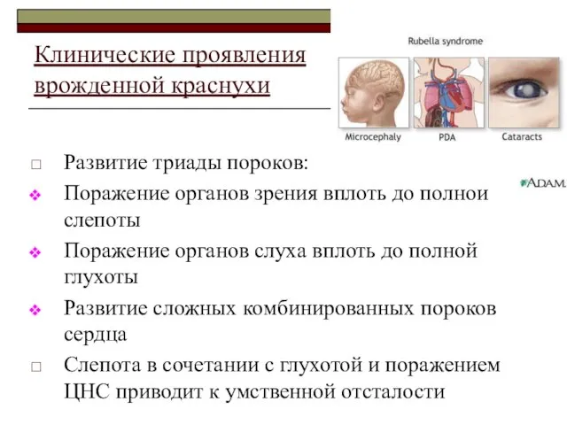 Клинические проявления врожденной краснухи Развитие триады пороков: Поражение органов зрения вплоть до