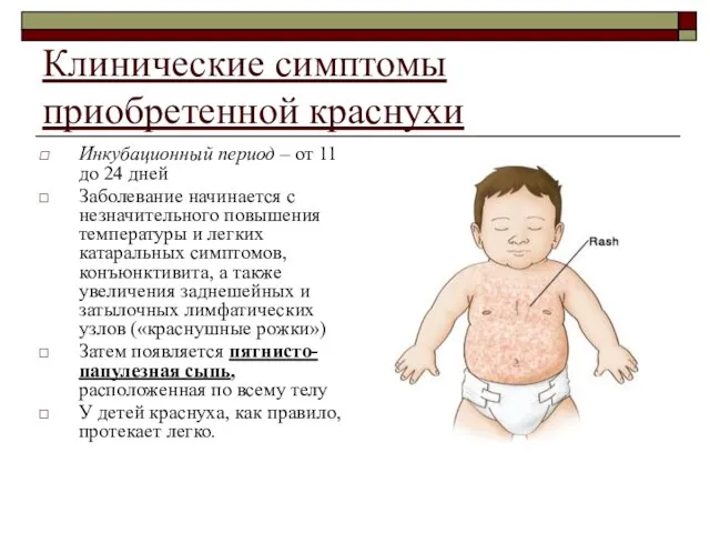 Клинические симптомы приобретенной краснухи Инкубационный период – от 11 до 24 дней