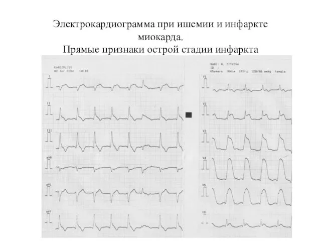 Электрокардиограмма при ишемии и инфаркте миокарда. Прямые признаки острой стадии инфаркта миокарда передней стенки