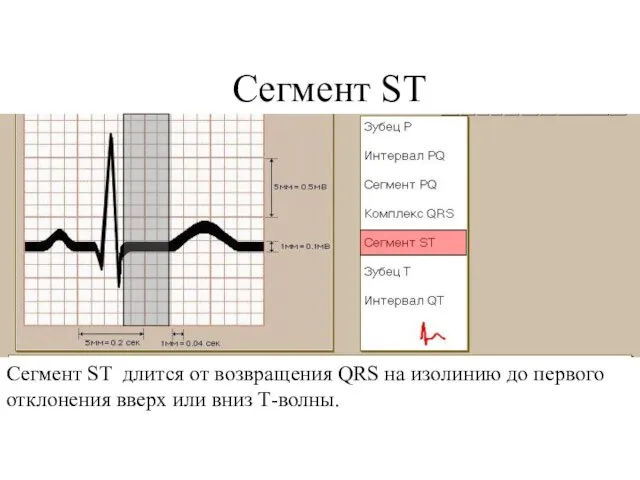Сегмент ST Сегмент ST длится от возвращения QRS на изолинию до первого