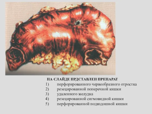 НА СЛАЙДЕ ПРДСТАВЛЕН ПРЕПАРАТ перфорированного червеобразного отростка резецированной поперечной кишки удаленного желудка