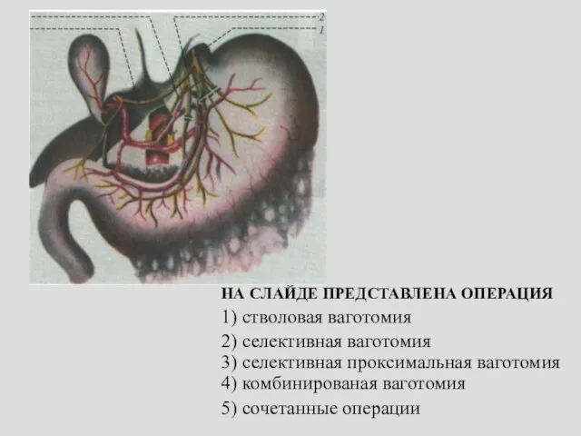 НА СЛАЙДЕ ПРЕДСТАВЛЕНА ОПЕРАЦИЯ 1) стволовая ваготомия 2) селективная ваготомия 3) селективная