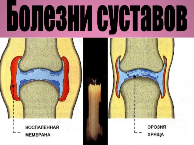 Болезни суставов