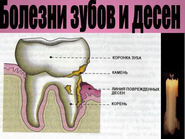 Болезни зубов и десен