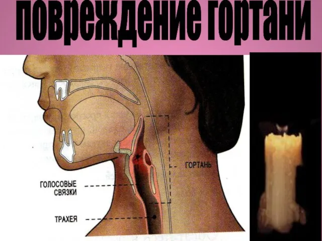 повреждение гортани