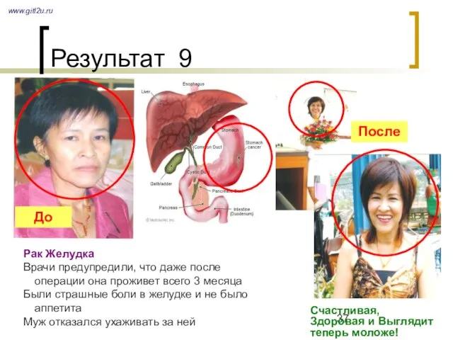 Результат 9 www.gitl2u.ru Рак Желудка Врачи предупредили, что даже после операции она