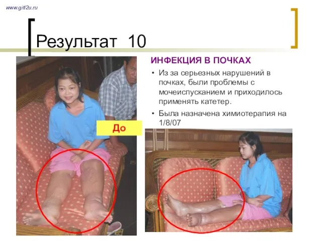 Результат 10 www.gitl2u.ru ИНФЕКЦИЯ В ПОЧКАХ Из за серьезных нарушений в почках,