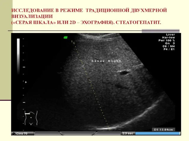 ИССЛЕДОВАНИЕ В РЕЖИМЕ ТРАДИЦИОННОЙ ДВУХМЕРНОЙ ВИЗУАЛИЗАЦИИ («СЕРАЯ ШКАЛА» ИЛИ 2D – ЭХОГРАФИЯ). СТЕАТОГЕПАТИТ.