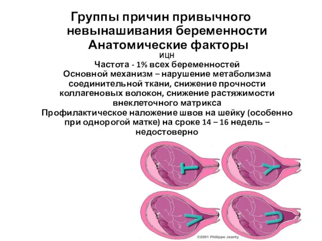 Группы причин привычного невынашивания беременности Анатомические факторы ИЦН Частота - 1% всех