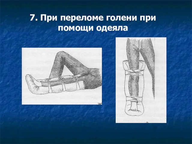 7. При переломе голени при помощи одеяла