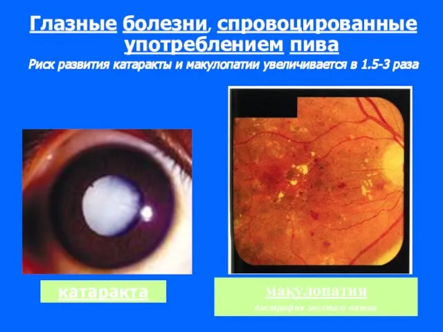 катаракта Глазные болезни, спровоцированные употреблением пива Риск развития катаракты и макулопатии увеличивается