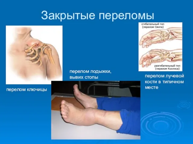 Закрытые переломы перелом ключицы перелом лодыжки, вывих стопы перелом лучевой кости в типичном месте