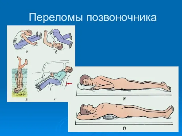 Переломы позвоночника