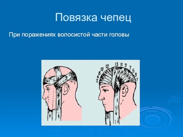 Повязка чепец При поражениях волосистой части головы