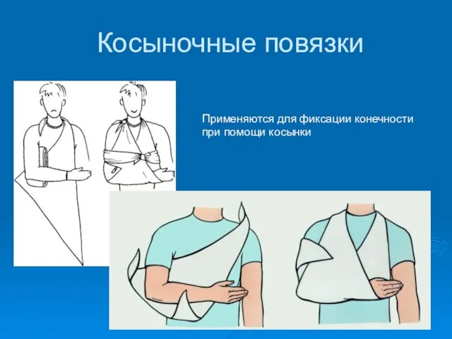 Косыночные повязки Применяются для фиксации конечности при помощи косынки