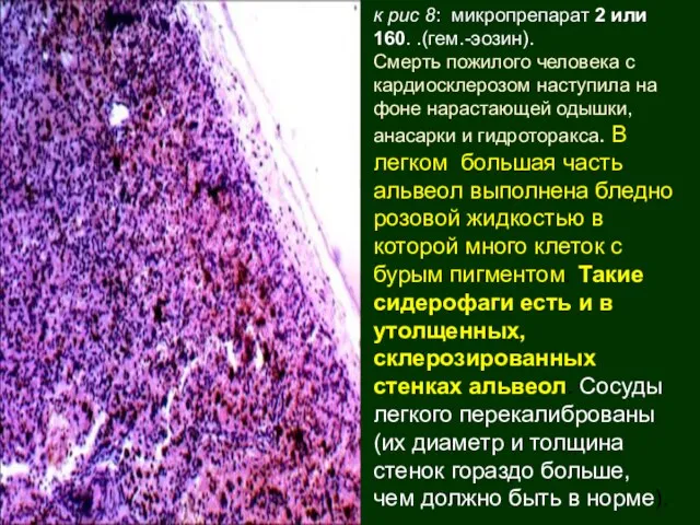 к рис 8: микропрепарат 2 или 160. .(гем.-эозин). Смерть пожилого человека с