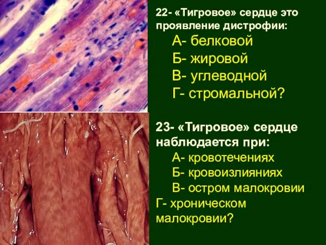 23- «Тигровое» сердце наблюдается при: А- кровотечениях Б- кровоизлияниях В- остром малокровии