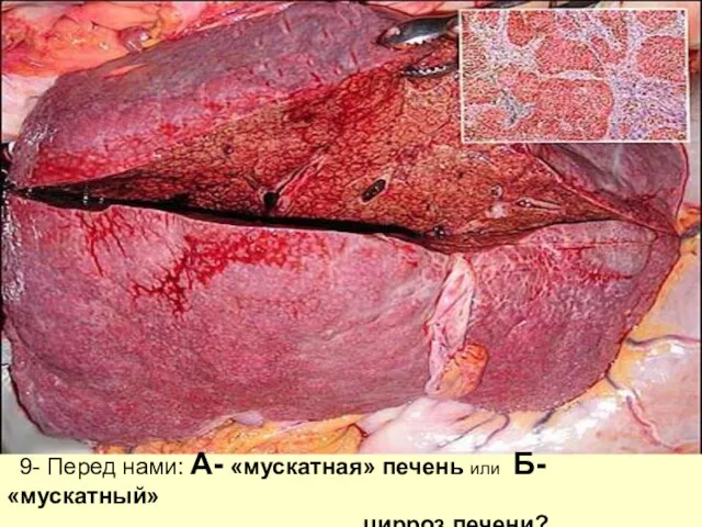 9- Перед нами: А- «мускатная» печень или Б- «мускатный» цирроз печени?
