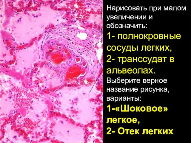 Нарисовать при малом увеличении и обозначить: 1- полнокровные сосуды легких, 2- транссудат