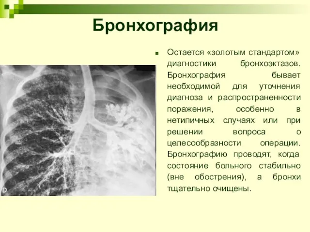 Бронхография Остается «золотым стандартом» диагностики бронхоэктазов. Бронхография бывает необходимой для уточнения диагноза