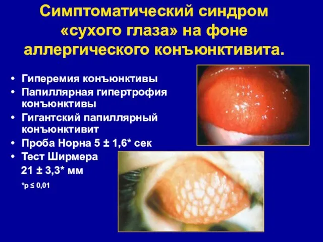 Симптоматический синдром «сухого глаза» на фоне аллергического конъюнктивита. Гиперемия конъюнктивы Папиллярная гипертрофия