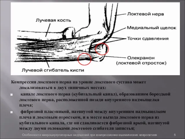 Компрессия локтевого нерва на уровне локтевого сустава может локализоваться в двух типичных