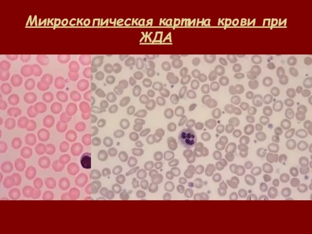 Микроскопическая картина крови при ЖДА