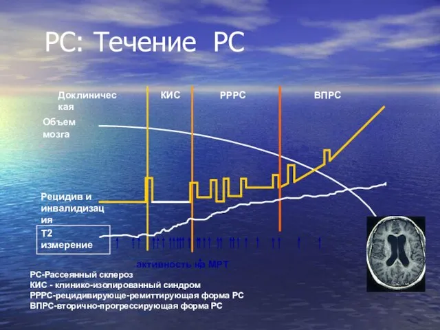 РС: Течение РС Доклиническая РРРС ВПРС КИС РС-Рассеянный склероз КИС - клинико-изолированный