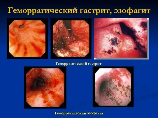 Геморрагический гастрит, эзофагит Геморрагический гастрит Геморрагический эзофагит