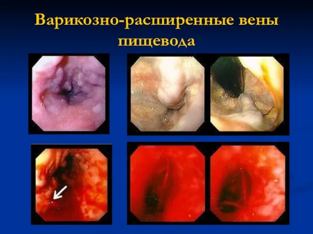 Варикозно-расширенные вены пищевода