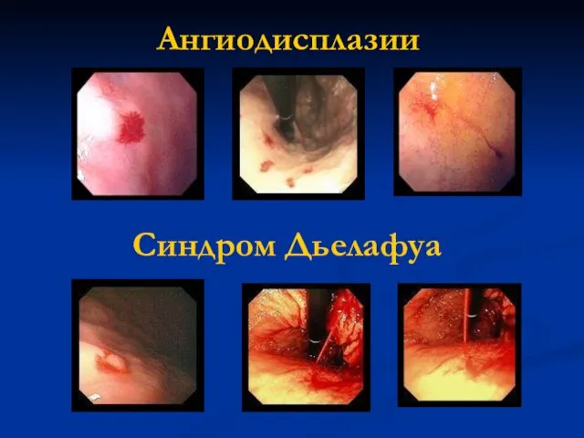 Ангиодисплазии Синдром Дьелафуа