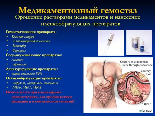 Медикаментозный гемостаз Орошение растворами медикаментов и нанесение пленкообразующих препаратов Гемостатические препараты: Кальция