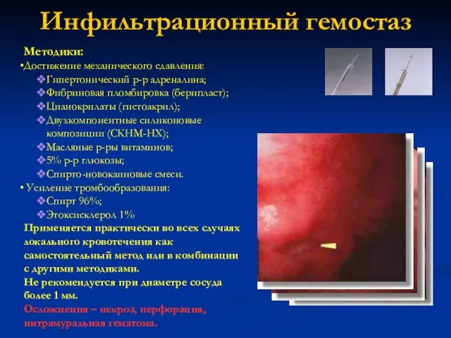 Инфильтрационный гемостаз Методики: Достижение механического сдавления: Гипертонический р-р адреналина; Фибриновая пломбировка (берипласт);