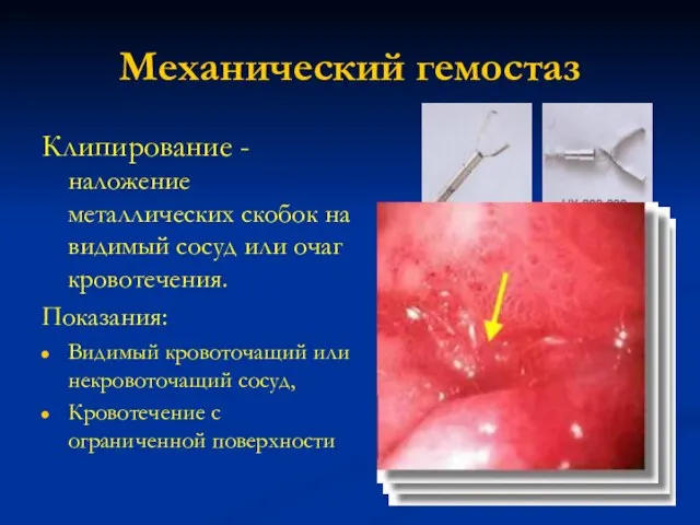 Механический гемостаз Клипирование - наложение металлических скобок на видимый сосуд или очаг