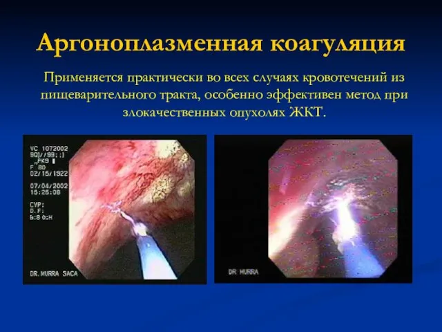 Аргоноплазменная коагуляция Применяется практически во всех случаях кровотечений из пищеварительного тракта, особенно