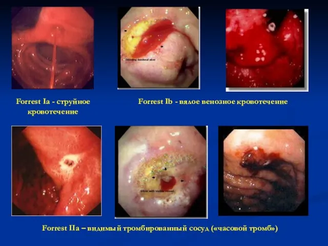 Forrest Ib - вялое венозное кровотечение Forrest Ia - струйное кровотечение Forrest