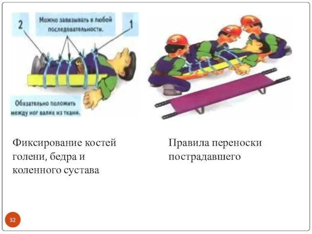 Фиксирование костей голени, бедра и коленного сустава Правила переноски пострадавшего