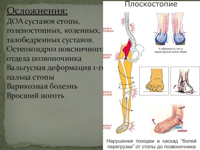 Осложнения: ДОА суставов стопы, голеностопных, коленных, тазобедренных суставов. Остеохондроз поясничного отдела позвоночника