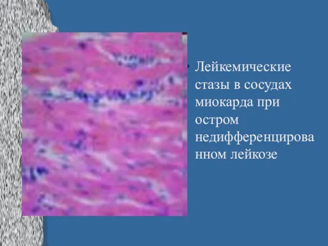 Лейкемические стазы в сосудах миокарда при остром недифференцированном лейкозе