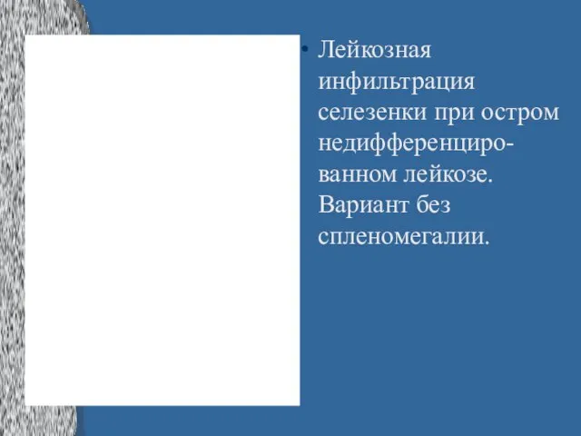 Лейкозная инфильтрация селезенки при остром недифференциро-ванном лейкозе. Вариант без спленомегалии.